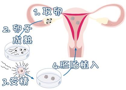 顕微授精 ICSI